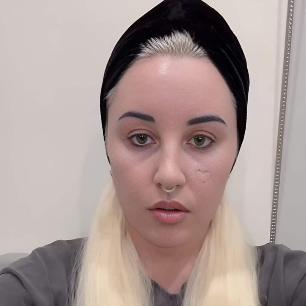 Amanda Bynes after Blepharoplasty